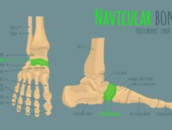 Accessory Navicular Surgery Procedure For Pain Relief